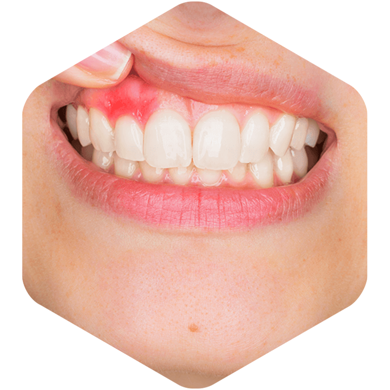 Smile showing Tooth Abscess